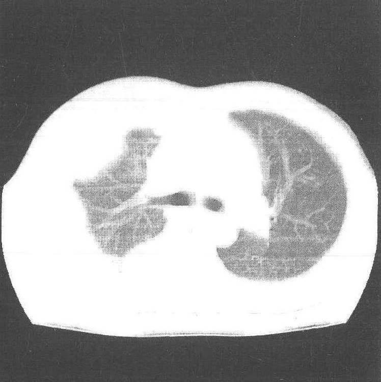 胸膜间皮瘤