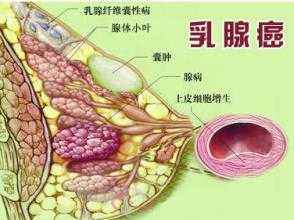 乳腺癌也为男性带来了真正的风险