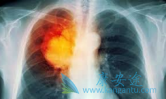 肺癌化疗期间注意什么