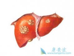治疗肝癌的方法都有那些盘点治疗肝癌的办法