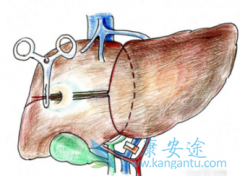 仑伐替尼可以作为多吉美耐药后的肝癌治疗选择吗？