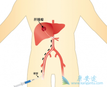 肝癌的注意事项一般有哪些呢