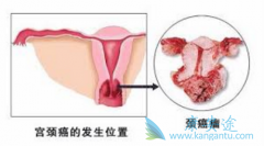 宫颈癌前病变的表现和原因是什么？