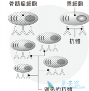深入了解多发性骨髓的症状