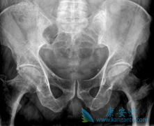 多发性骨髓瘤患者的检查有哪些?