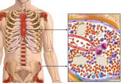 多发性骨髓瘤的诊断过程