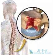 多发性骨髓瘤的食疗法有哪些?