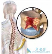 多发性骨髓瘤怎么用药呢