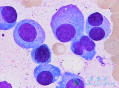 多发性骨髓瘤患者要做好护理工作