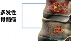 多发性骨髓瘤的治疗方法大盘点