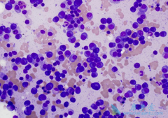 多发性骨髓瘤化疗需注意些什么？