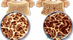 多发性骨髓瘤常见的症状有哪些?