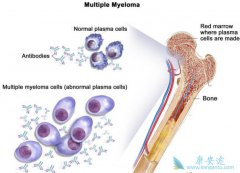 老年人患多发性骨髓瘤需要做哪些检查