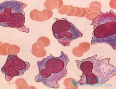 发生多发性骨髓瘤的原因有什么?