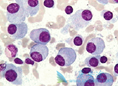 选择专业多发性骨髓瘤治疗方法