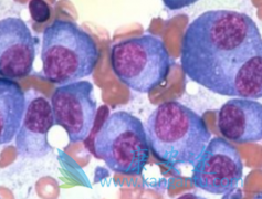 多发性骨髓瘤引起的原因有哪些