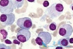 为什么会得多发性骨髓瘤