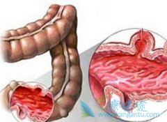结肠扭转应该做哪些检查？