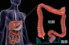 如何预防结肠癌