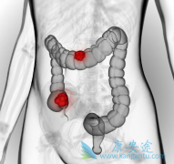 急性胃肠炎都有哪些并发症？