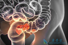 直肠癌是如何形成的