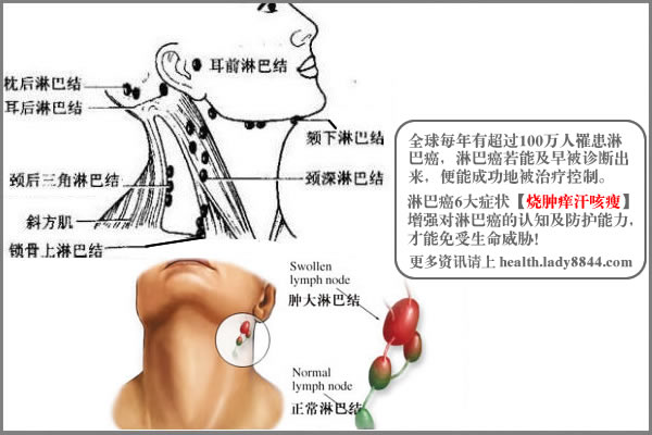 霍金淋巴瘤的体征和症状