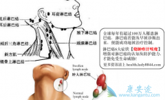 非霍奇金淋巴瘤的发病机制