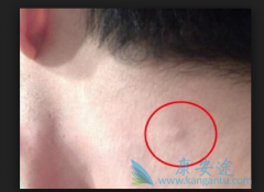 淋巴瘤样丘疹病应该如何预防？