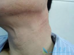 淋巴瘤样丘疹病有哪些表现及如何诊断？