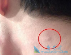 淋巴瘤的具体病因有哪些