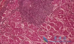 淋巴瘤引起的肾损害有哪些表现及如何诊断？