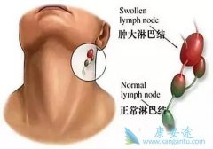 淋巴瘤治疗前的注意事项