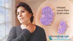 淋巴瘤是由什么原因引起的？