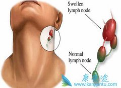 淋巴瘤应该做哪些检查？