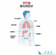 淋巴瘤疾病的临床表现