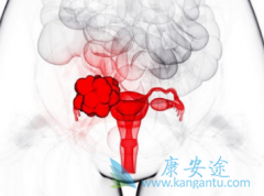 卵巢癌伴发腹水的原因有哪些