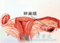 滥用促排卵药物可致卵巢癌发病率飙升