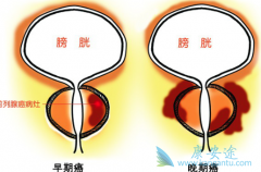 前列腺炎是否会传染呢?