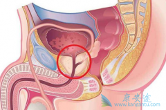 早期前列腺增生的症状是什么