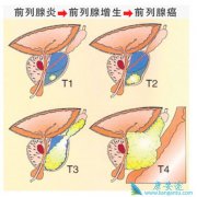 前列腺癌手术和化疗适应证