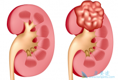 肾癌晚期存活期是多久