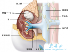 肾癌患者怎么服用多吉美才能将疗效发挥到最大？