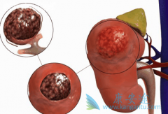 是什么引发了肾癌