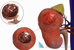 如何有效预防肾癌