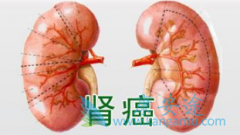 肾癌治疗有什么好的饮食调养秘诀？