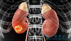 肾癌患者饮食要以易消化为主