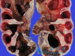 如何自我诊断肾癌疾病