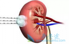 肾癌症状有哪些