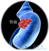 肾癌的预后