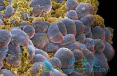 常用肾癌的病理分期方法有哪些